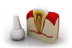 Dental Implant X