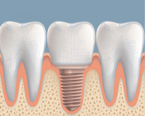 dental implant
